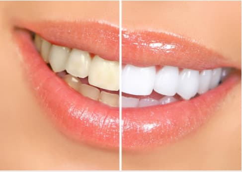 Blanchiment des dents, Hawkesbury Dentist