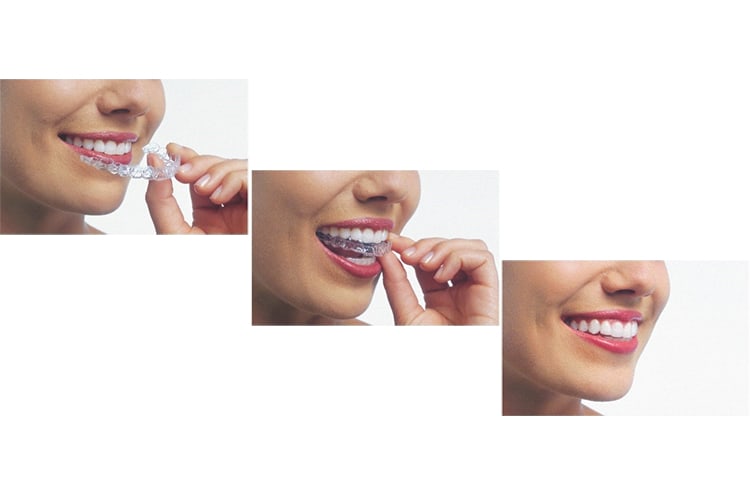 Invisalign, Dentiste à Hawkesbury